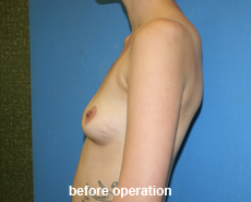 plastic-surgery-breast-augmentation